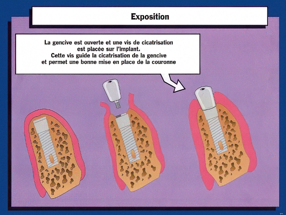 exposition implant dentaire Strasbourg